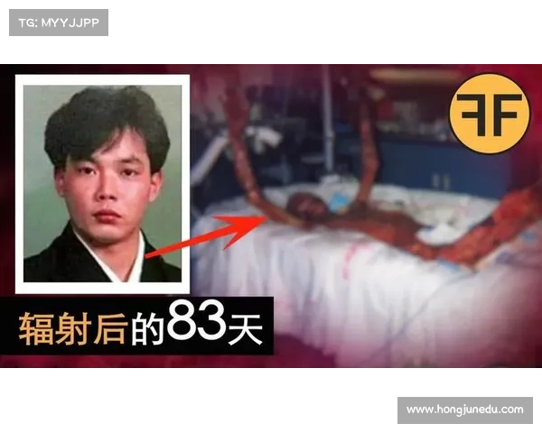 辐射病治疗方法大揭秘 辐射病治疗方法大揭秘